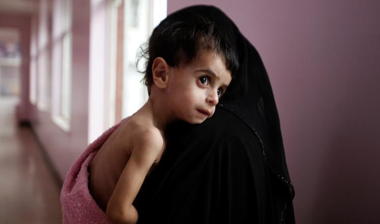 ارتفاع معدلات سوء التغذية الحاد يهدد أطفال اليمن
