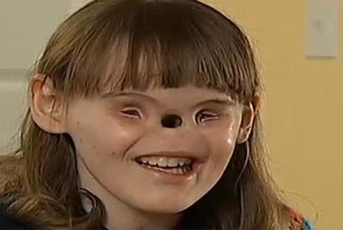 فتاة أميركية بدون أنف وعينين تتحضر لجراحة نادرة