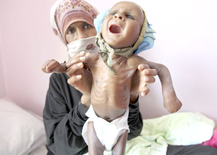 «اليمن السعيد» يجوع