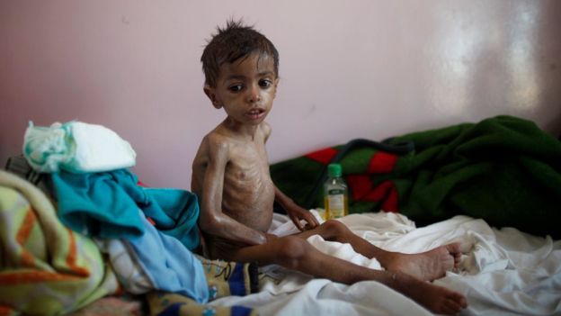 طفل يعاني من نقص التغذية في مركز للطفولة في العاصمة اليمنية صنعا