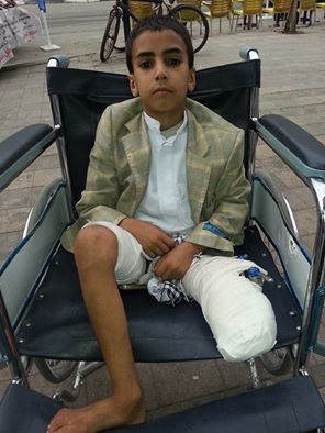 خطأ طبي بمستشفى الثورة في صنعاء يتسبب ببترقدم طفل