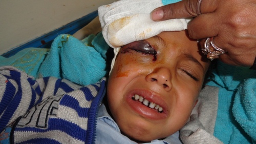 كلب مسعور يقتلع عين طفل بمدينة إب
