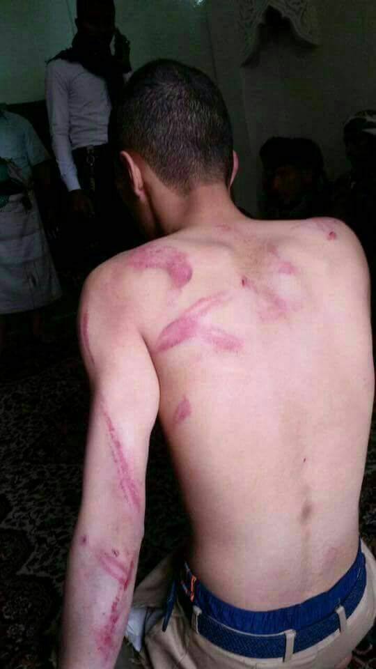 تعرض طالب بإحدى مدارس صنعاء للضرب بطريقة وحشية من قبل مدير المدرسة وعدد من مدرسيها (صور)