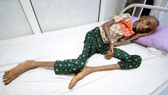 الصليب الأحمر: شهور فقط تفصل ملايين اليمنيين عن الموت جوعاً