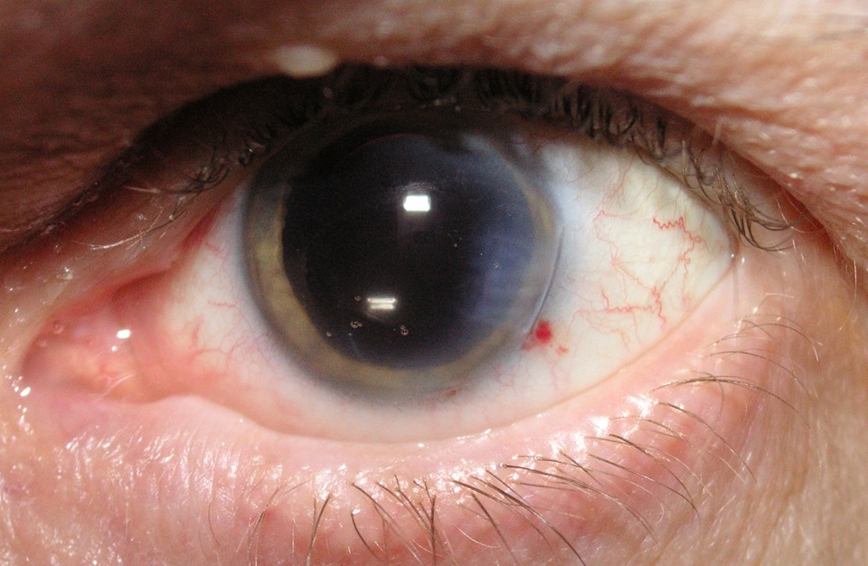 تعرف على 7 أعراض قد تظهر على عينيك.. ودلالاتها