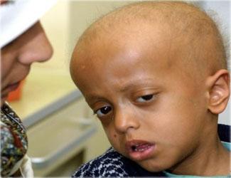السرطان يغزو قرية يمنية ويخلف عشرات الموتى والمصابين