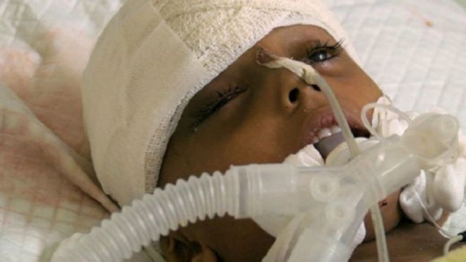 الصراع في اليمن: فتاة ومدينة تصارعان من أجل الحياة (تقرير لـ b b c )