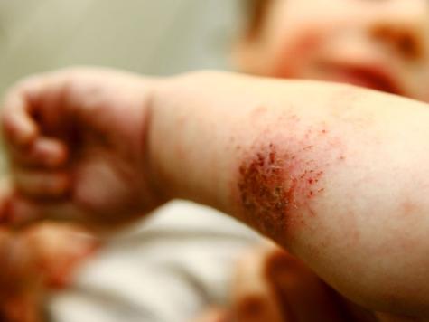 الطفح الجلدي والحكة الشديدة مؤشران على إصابة الطفل بالجرب (الألم