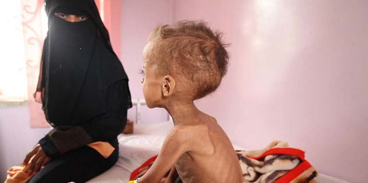 مجاعة تهدد اليمن