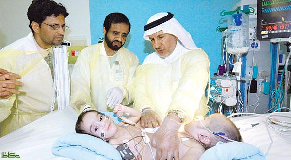 فريق طبي سعودي يجري عملية فصل توأم يمني يوم غدٍ الجمعة
