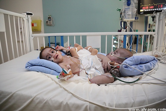 نجاح عملية فصل التوأم السيامي اليمني بمستشفى الملك عبدالله بمشاركة 30 طبيبا