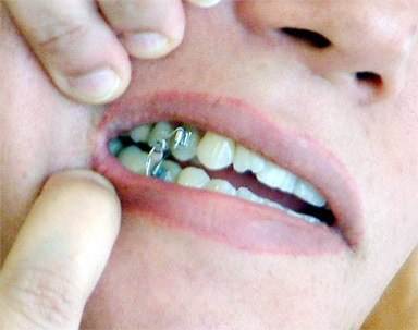 انتشار ظاهرة عمليات ربط الأسنان بين السعوديات طلباً للرشاقة
