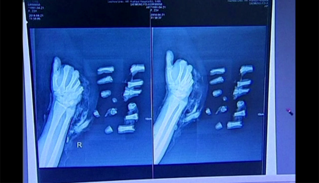 جراحون صينيون يعيدون تجميع يد مقطّعة (فيديو)
