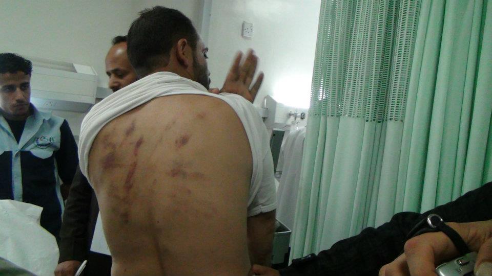 أحد المواطنين تعرض لتعذيب مليشيات الحوثي - أرشيف